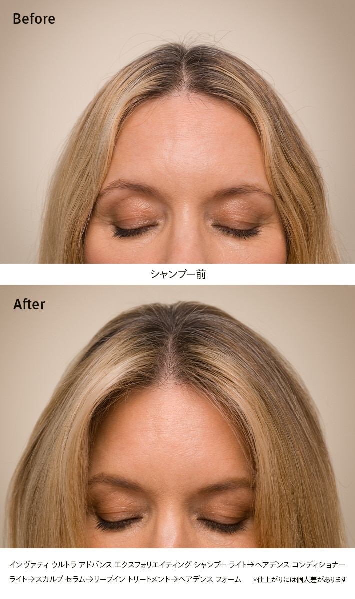 Invati Ultra Advance Trial Set
